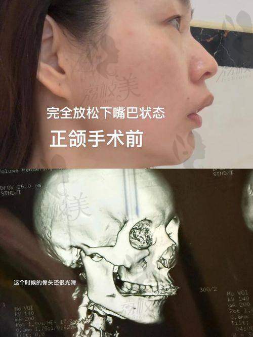 李自力正颌技术有多牛？一句话总结：靠谱+好看+修复快！