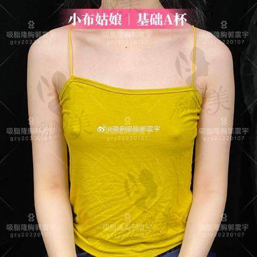 王世虎医生在脂肪丰胸领域的资历如何？