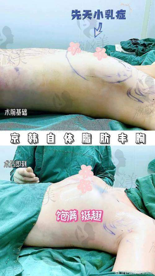 广州军美王世虎做脂肪丰胸的口碑如何？