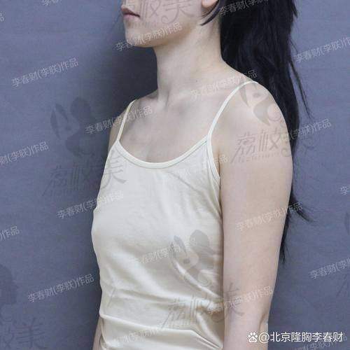 广州军美王世虎做脂肪丰胸的成效怎么样？