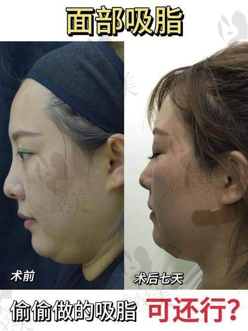 杭州丽脂医疗美容陈旭华面部吸脂：开启你的美丽之旅