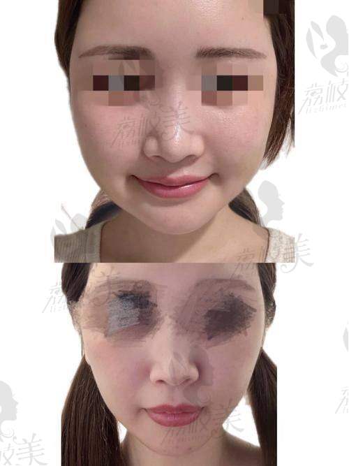 杭州丽脂医疗美容陈旭华面部吸脂：技术优势大揭秘