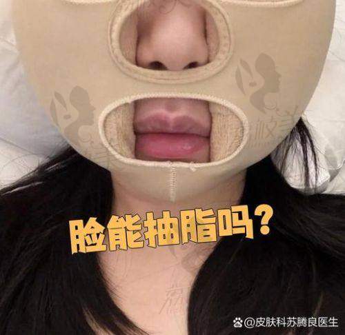 杭州丽脂医疗美容陈旭华面部吸脂：真人实例大展示