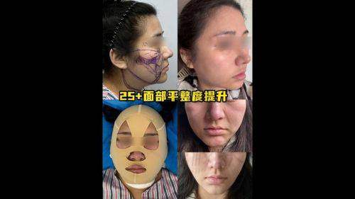 杭州丽脂医疗美容陈旭华面部吸脂：口碑评价大分享