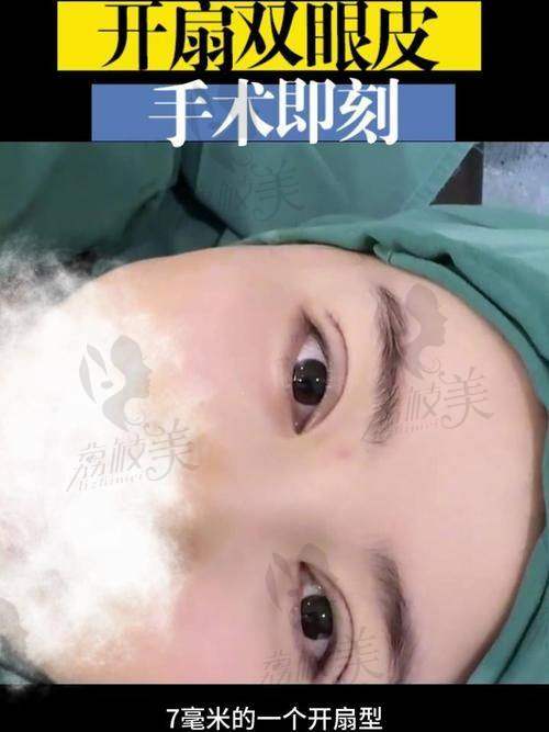 宜昌亚太整形美容医院陈政军KISS重睑法6980起，灵动双眸轻松get，效果惊艳超吸睛 