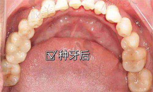 北京美冠塔口腔医院镶牙价格2980元起·轻松“吃”回好状态，稳固耐用超乎想象！