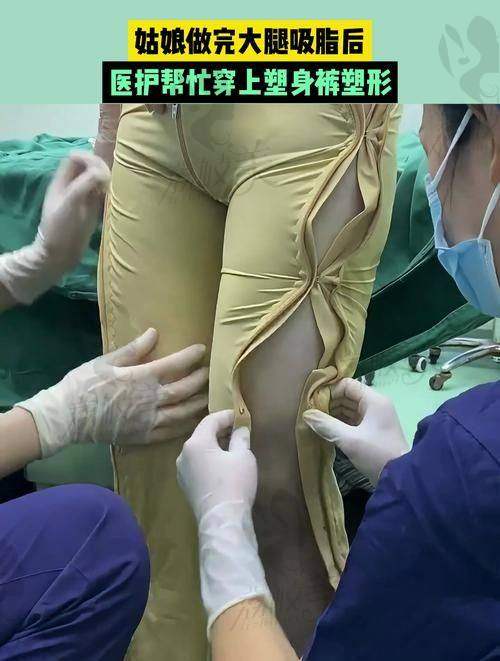 北京润美玉之光王明利操刀大腿吸脂，仅58000元起开启美腿焕变之旅！ 