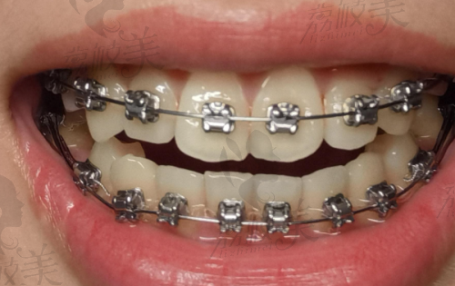 佛山曙光金子口腔是什么档次？德国数字化种植中心，30年口碑老院种牙1176元起