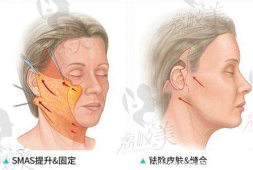 北京米兰柏羽丽都医疗美容医院除皱：精良的技术与设备优势