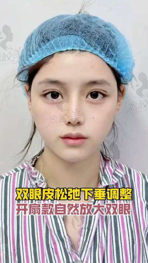 重庆双眼皮修复技术厉害的医生，让你的失败双眼皮重焕光彩！