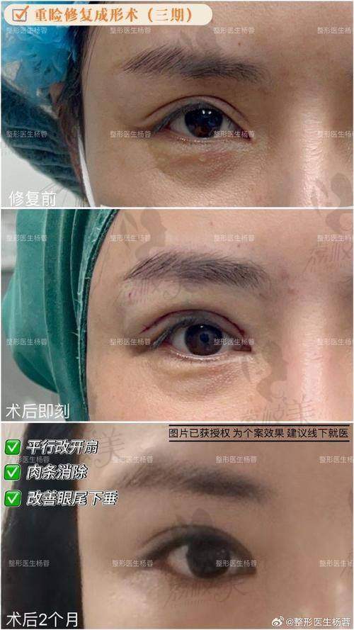 宜昌亚太整形美容医院陈政军双眼皮3980起，精细技艺打造自然灵动美眼效果 