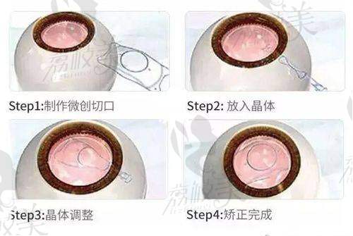 桂林爱尔眼科医院价格表：