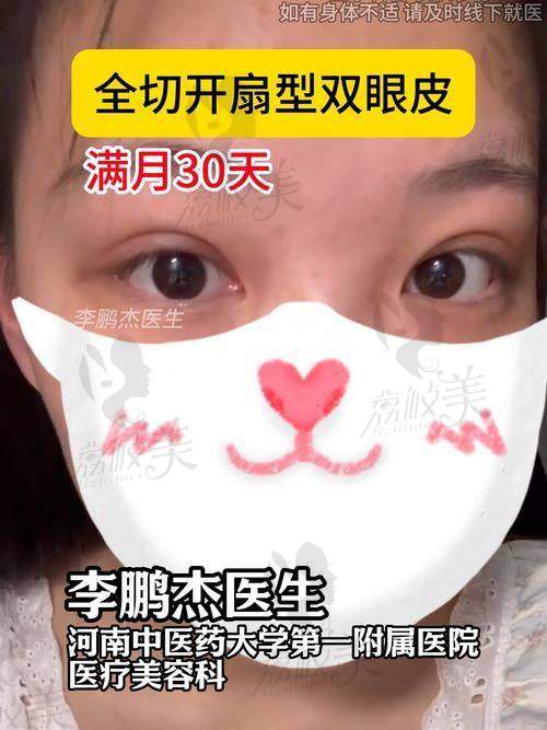张恒术医生做双眼皮常见问题解答
