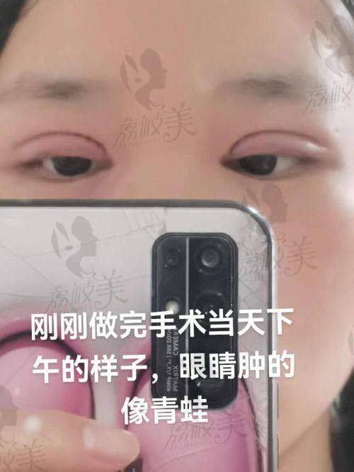张恒术医生割双眼皮收费标准解析