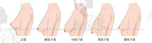 6. 成都华美紫馨唇腭裂鼻畸形修复——专精修复，价格区间明确