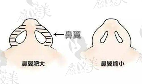 深圳非凡医院梅够明院长，单侧耳软骨隆胸震撼来袭，仅19800元起！ 