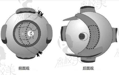 3. 肇庆市第一人民医院眼科全飞秒激光手术价格及优惠
