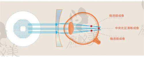 2025依视路星趣控镜片价格大揭秘！790元起即享专业护眼体验