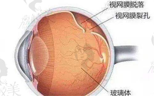 4. 2025年贵州华厦眼科医院EVO ICL晶体植入手术费用表