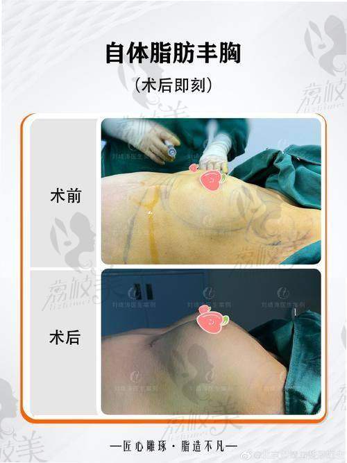 5. 艾剑英医生隆胸价格与专精技能
