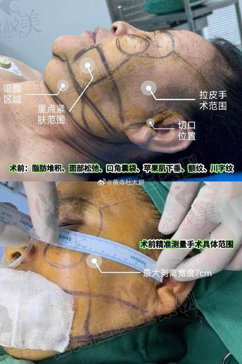 在考虑北京闫立新医生小切口提升费用时，还需要注意什么？