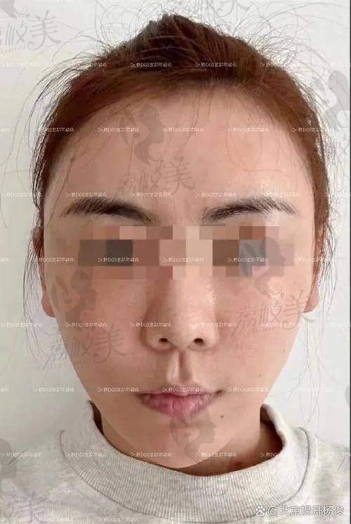 如何降低北京闫立新医生小切口提升的费用？