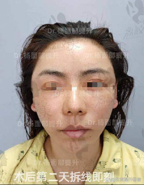 北京闫立新医生小切口提升费用的影响因素有哪些？