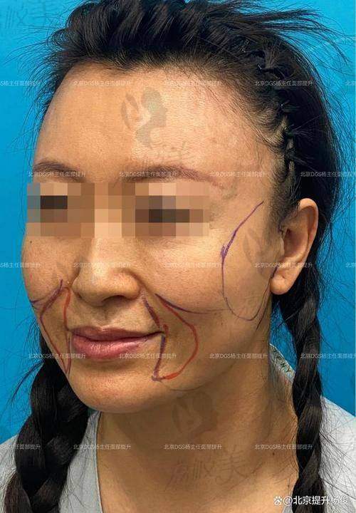 与其他医生的小切口提升费用相比，北京闫立新医生的费用有何特点？