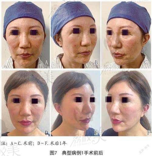 想了解北京闫立新医生小切口提升大概费用多少？这篇文章为你详细揭秘！