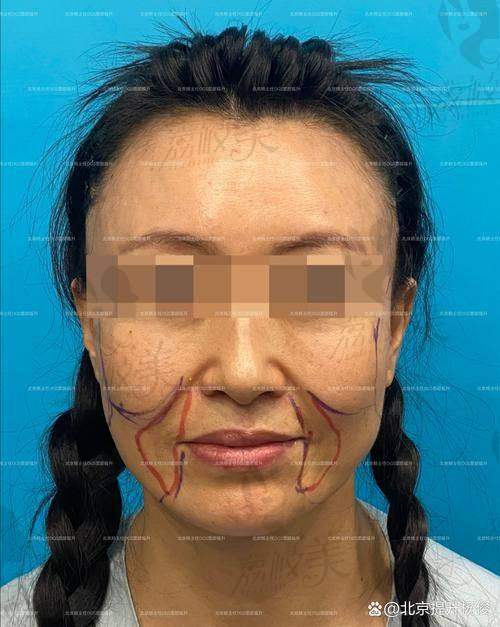 北京闫立新医生在小切口提升领域的地位如何？