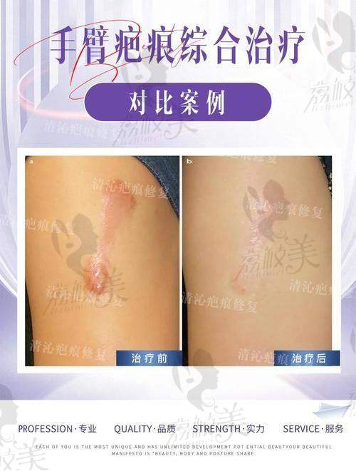 成都疤研疤痕医院是正规医院吗？专注疤痕修复20年，SRT-100浅放技术获国际认证