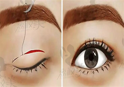 四川大学华西医院许学文医生做双眼皮15800元起，技术精湛审美在线