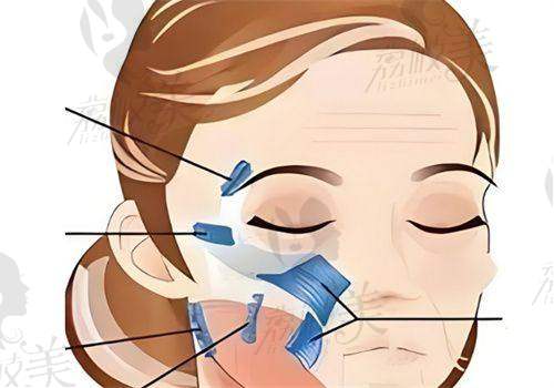 成都春天整形医院周斌珊瑚骨精微提:口碑评价超棒