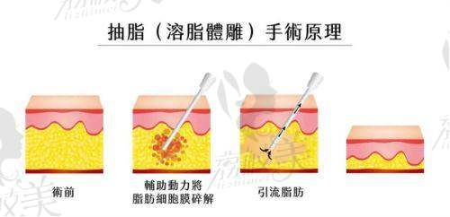 刘自飞医生技术特点：