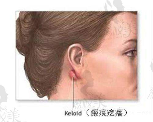 西宁澳丽医疗美容余红敏双眼皮整形服务优势