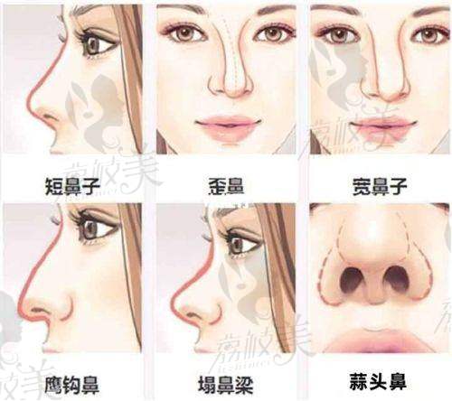 卢元刚手术价格贵吗？看完价格表你就放心