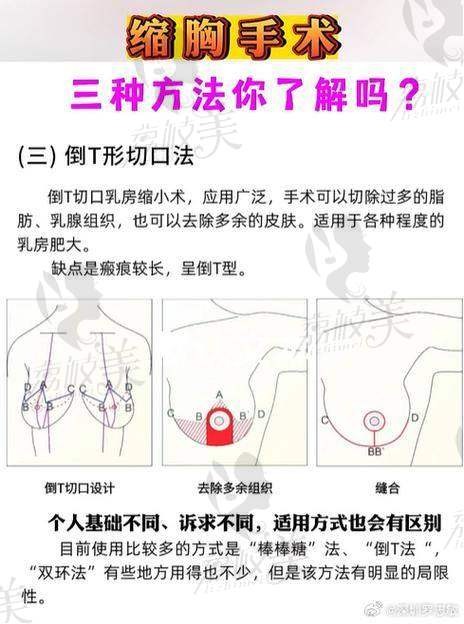 成都春天整形医院周斌:39800 元起,开启胸部“逆袭”之旅