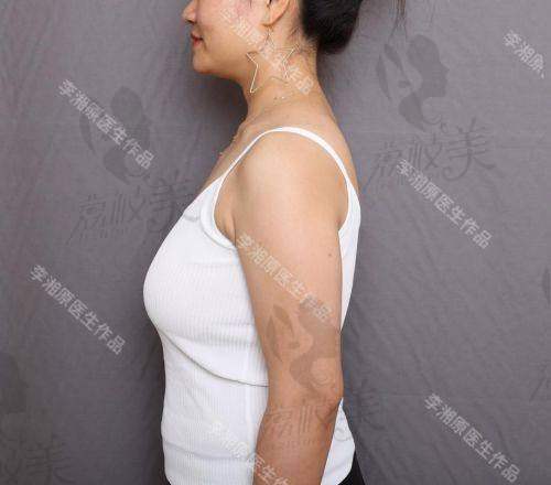 成都春天整形医院周斌胸部下垂矫正:口碑爆棚,好评如潮