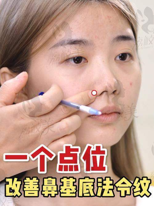 深圳艺星邓璐雯用大玻尿酸去除法令纹，仅需4000元起开启年轻焕颜之旅 