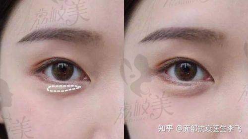 南京卧蚕手术医院排名榜前三，为你甄选靠谱医美机构！