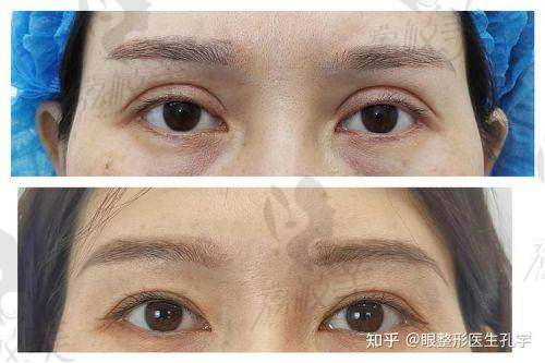蔡灵做普通全切双眼皮到底适合哪些人？
