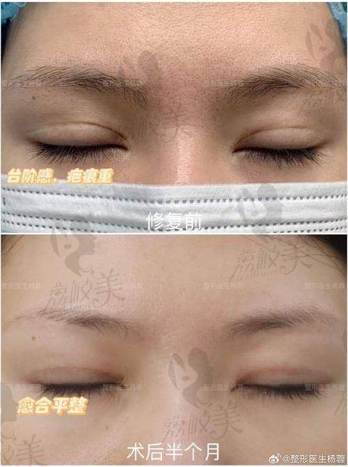 实例口碑TOP 1：肿眼泡逆袭“狐狸钓系眼”，下凡小仙女的真实故事