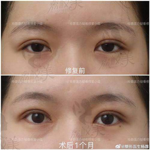 蔡灵做普通全切双眼皮口碑