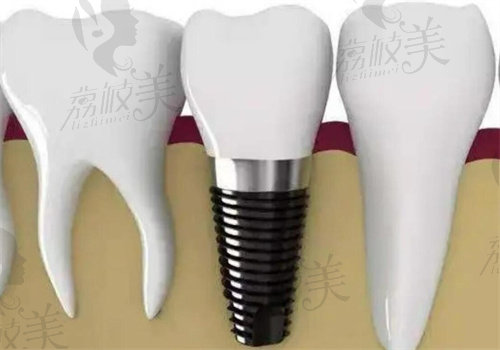 广州牙德堡口腔种植牙怎么样？价格亲民+技术过硬，真实患者反馈揭秘！