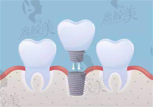 2026雅贝康口腔医院最新价目表：全国连锁机构透明收费一览（有种牙、正畸、补牙、根管治疗等价格）
