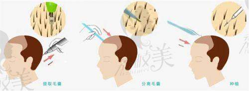 碧莲盛植发2500单位价格揭秘一下，顺便聊聊多少钱一个单位是不是头等大事