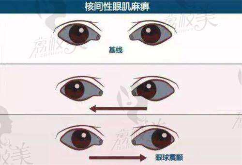 徐州一院近视手术价格揭秘！全飞秒19800元起，学生享9折优惠