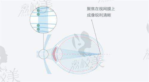 邵阳中心医院眼科2025近视手术价格公开：全飞秒21000元起，ICL矫正32000元起