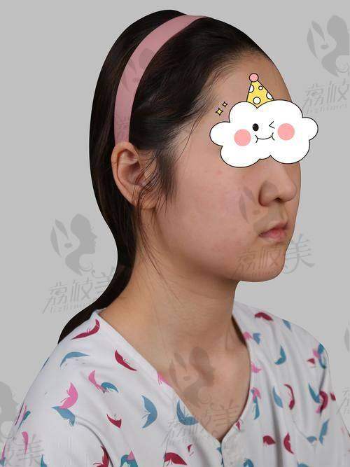 北京李长富隆鼻案例真实测评，“三维立体支架” 技术塑造精致美鼻！