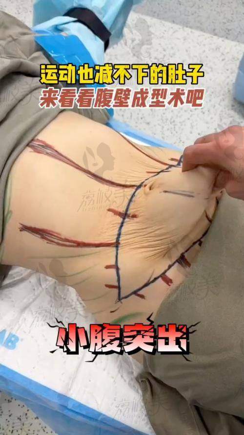 结尾总结：想吸脂不踩雷，选丛晓斌准没错！